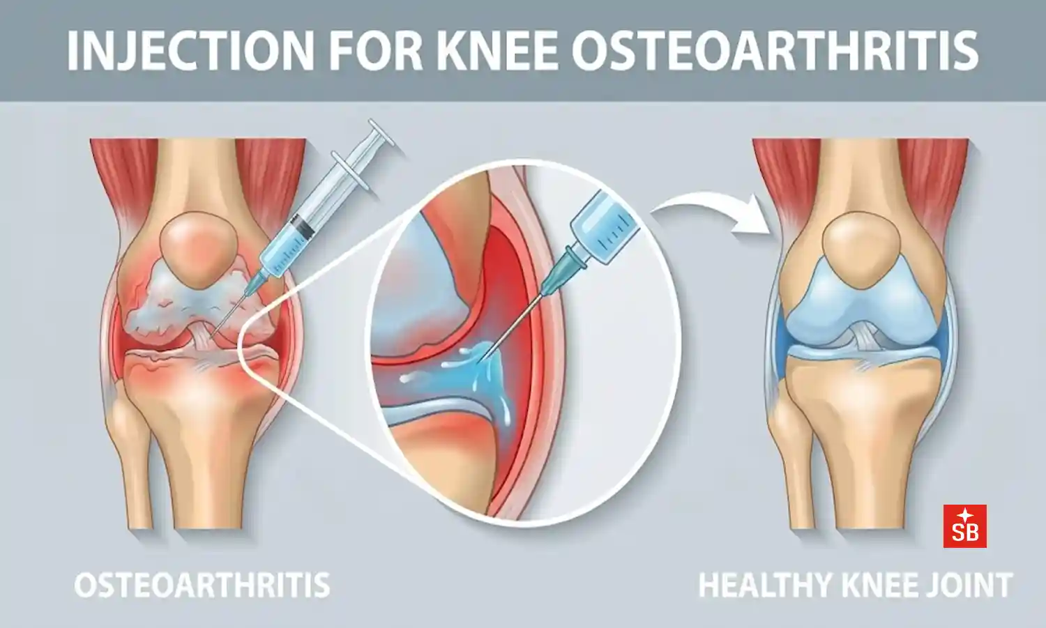 Lubricating the gearbox: myths, truths, and real science behind knee injections