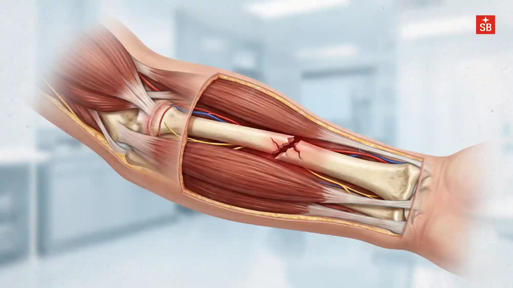 Your broken bone isn’t healing alone